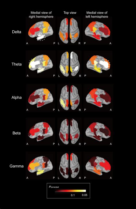 Increased Intrinsic Connectivity Of The Default Mode Network In