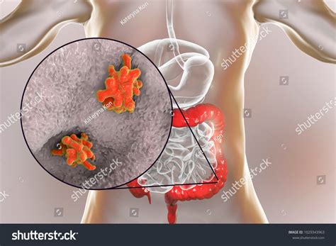 Entamoeba Histolytica Protozoan Infection Large Intestine Stock Illustration 1029343963