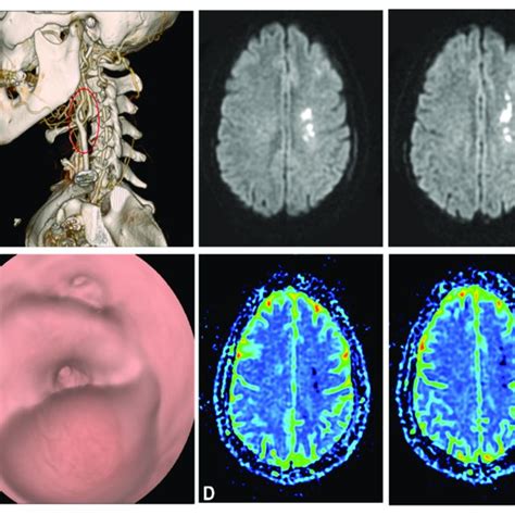 Ab Ct Angiogram With Three Dimensional Reconstruction Depicting