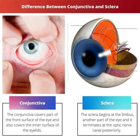 Conjunctiva Vs Sclera Difference And Comparison