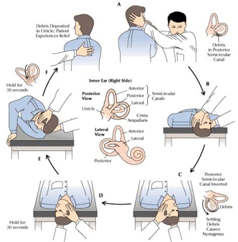 Benign Paroxysmal Positional Vertigo Bppv Is One Of The Most Common Causes Of Vertigo â The