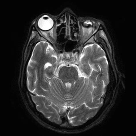 Phthisis Bulbi Image Radiopaedia Org