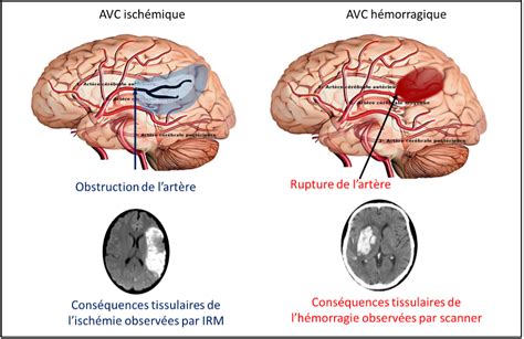 Accident Vasculaire Cerebral Avc Les Sympt Mes Surveiller Une