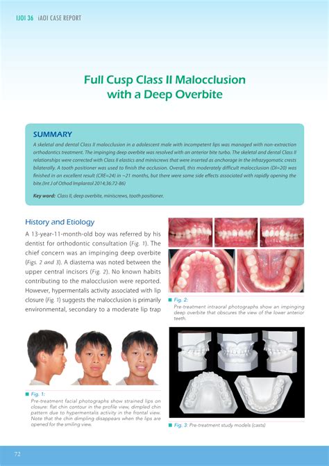 Full Cusp Class Ii Malocclusion With A Deep Overbite Ijoi 36 Docslib