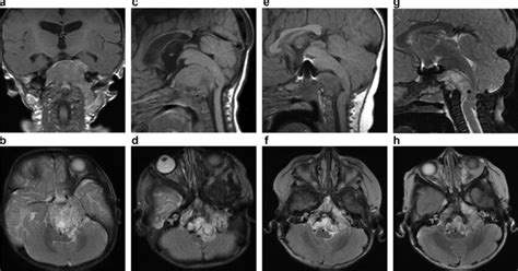 Ad Initial Diagnostic Imaging Demonstrating A Heterogenous Mass