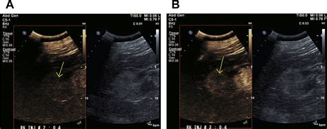 Ultrasound Of Renal Masses Radiologic Clinics