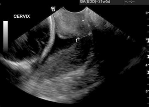 Placenta Umbilical Cord Cervix Amniotic Fluid Flashcards Quizlet