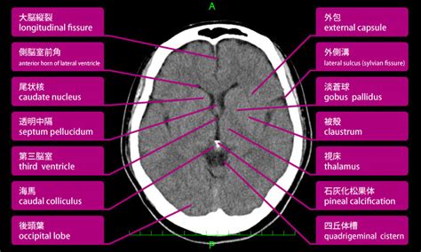 頭部ct（脳ct）正常像の各名称 救命救急センター 東京医科大学八王子医療センター
