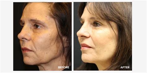 6 Best Sculptra Before and After Photos | RealSelf News