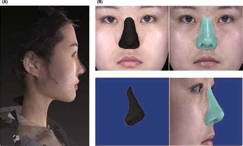 Measurement Of Nasal Volume Changes A Overlaying Preoperative And