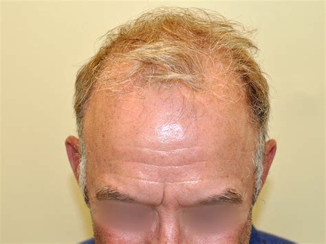 What Causes Hair Loss Types Of Hair Loss Follicle Ht