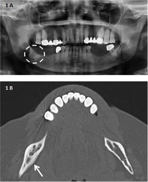 Osteonecrosis Maxilar Relacionada Con La Medicaci N El Papel Del