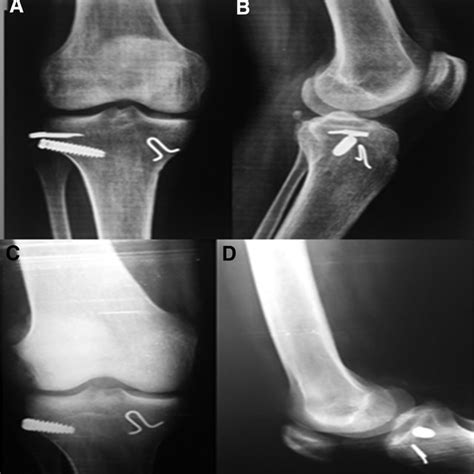 A Postoperative Anteroposterior And B Lateral Radiographs Of The