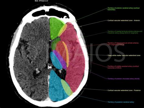 Vasculary territories, Territory of middle cerebral artery (cortical branches of MCA), Territory ...