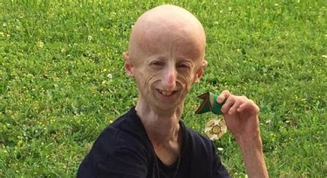 Progeria Cos La Malattia Di Cui Soffriva Sammy Basso Causa Sintomi