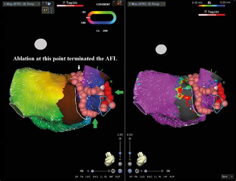 Radiofrequency Catheter Ablation Points Around The Right Pulmonary