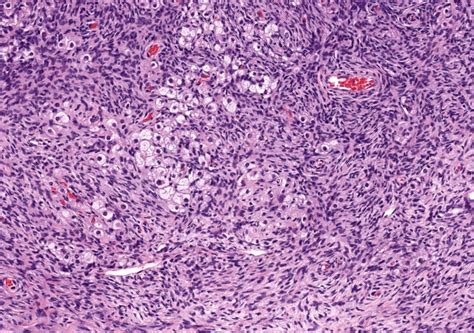 Ovary Stroma Histology