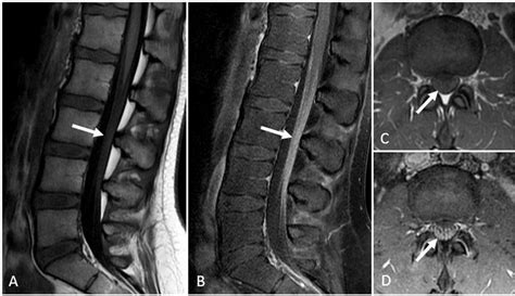 Nerve root enhancement in Guillain Barré syndrome Practical Neurology