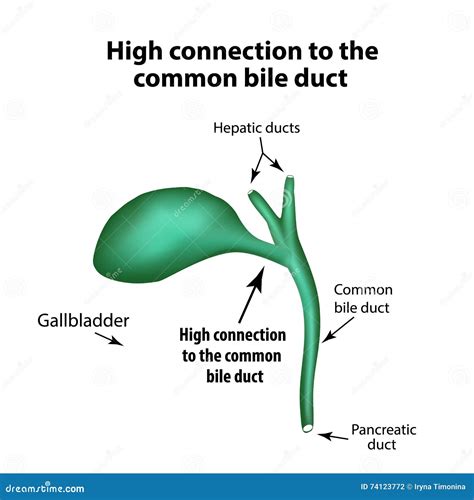 High Connection To the Common Bile Duct. Pathology of the Gallbladder ...