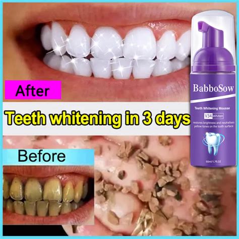 Days Whitening Teeth Mousse Toothpaste Prevent Tooth Decay Remove