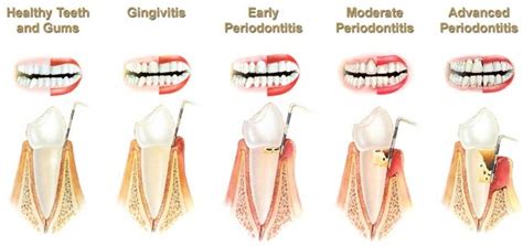 What Is Periodontal Disease Bergen Smiles Dental Clinic