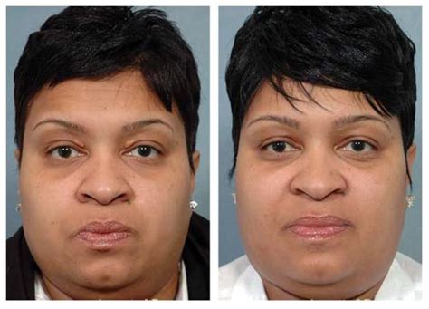 Plastic Surgery Before And After: Scar Removal Before And After