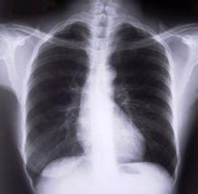 MBBS (Mal) and beyond: Quick Revision 1 - CXR Features of COPD