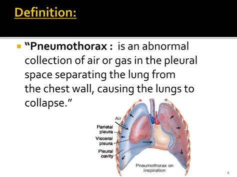 Pneumothorax 1 Pptx Definition Types Clinical Features Diagnosis