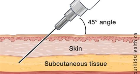 Subcutaneous Intramuscular Injections Flashcards Quizlet