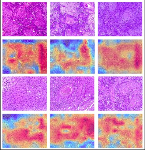 Table From Histopathology Based Diagnosis Of Oral Squamous Cell