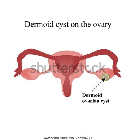 Dermoid Cyst Ovary