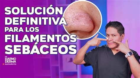 SOLUCIÓN DEFINITIVA PARA LOS FILAMENTOS SEBÁCEOS YouTube