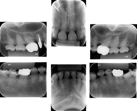 Periapical Radiographs At Permanent Dentition Stage Showing The Thin