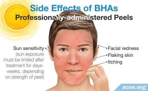 How Beta Hydroxy Acids BHAs Help With Acne Acne Org