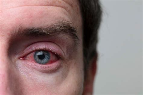 Conjuntivitis Causas Síntomas Y Cómo Tratarla En Casa Diabetes Con Amor