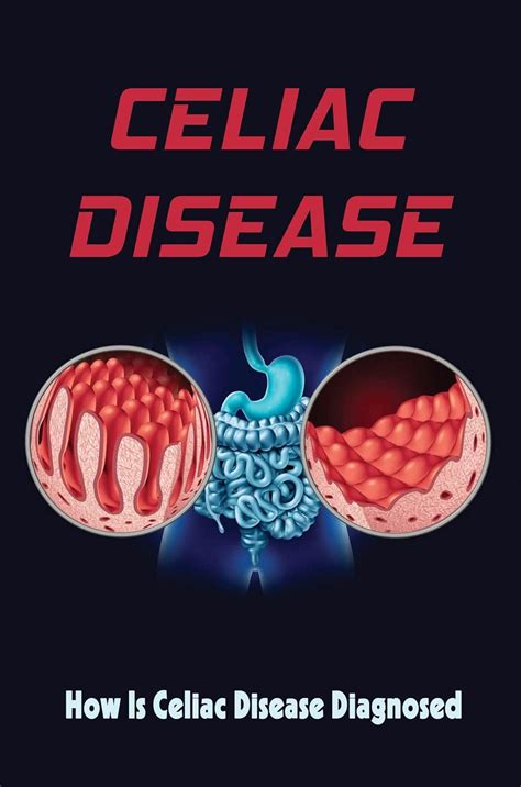 Celiac Disease How Is Celiac Disease Diagnosed Ebook Greaver