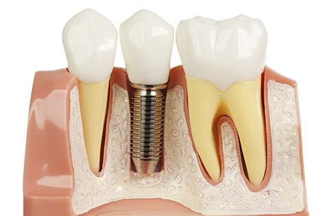 Dental Implants — Launceston Periodontics And Dental Implants