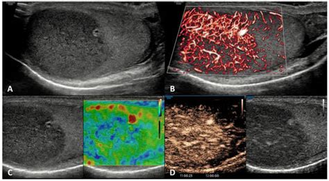 Cancers Free Full Text Multiparametric Ultrasound For Diagnosing