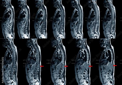 Magnetic Resonance Imaging Of Human Spine Mri Of Lumbar And Thoracic