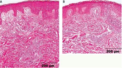 Histopathology Skin Punch Biopsy Severe Edema Of The Open I