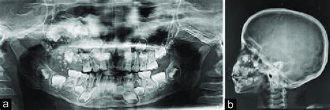 A Mixed Radiolucent Lesion With Multiple Radiopaque Foci Evident In The