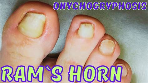 Ram S Horn Toenails Onychogryphosis YouTube