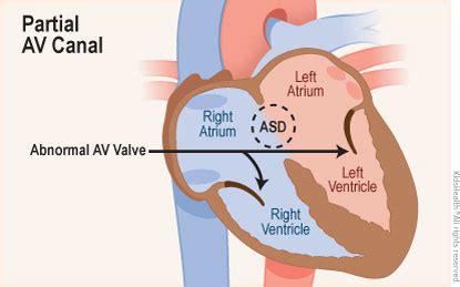 Atrioventricular Canal Defect (for Parents) - Children's Health Network