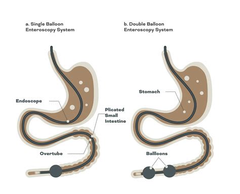 Deep Enteroscopy In Singapore Gastrohealth Clinic Dr Bhavesh