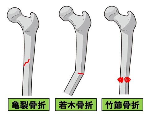 【基礎から学ぶ】骨折の種類【整形外科学】 Ptot国家試験対策ブログ