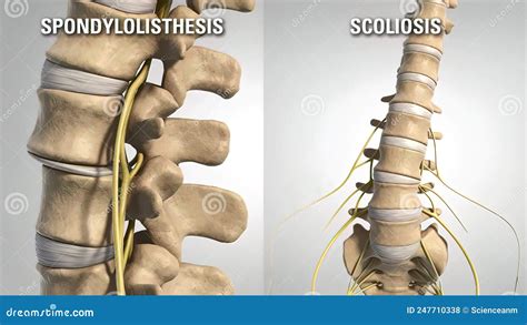 Enfermedad Del Disco Lumbar Degenerativo Stock De Ilustración