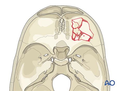 Skull base fracture, anterior