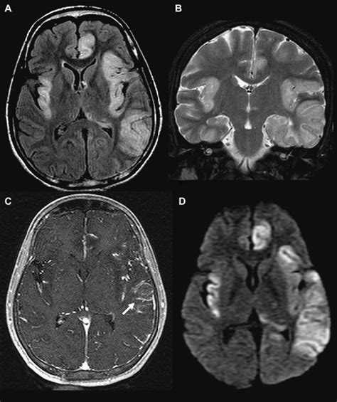 Diffusion Imaging In Brain Infections Radiology Key