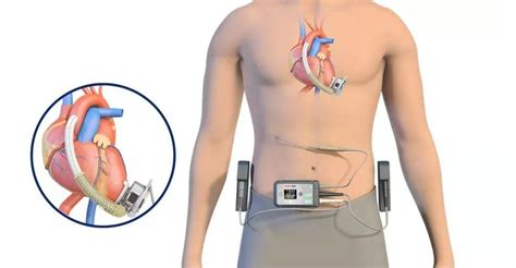 苏州同心医疗器械植入式左心室辅助系统设备获批上市！ 知乎