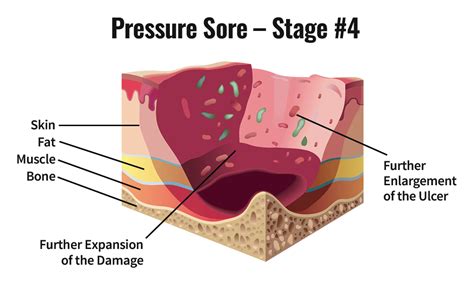 Skin Ulcer Stages